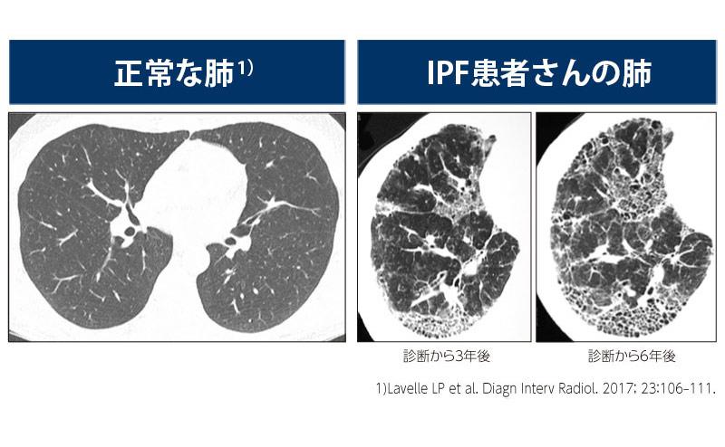 肺線維化の進行図
