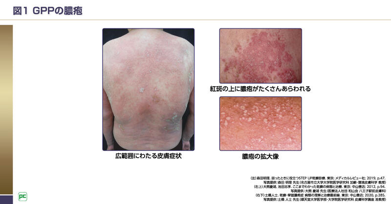 GPPの特徴と診断基準