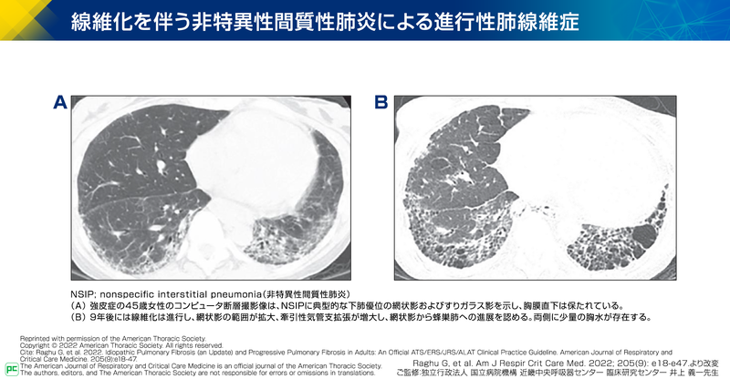 進行性肺線維症(PPF)の定義03