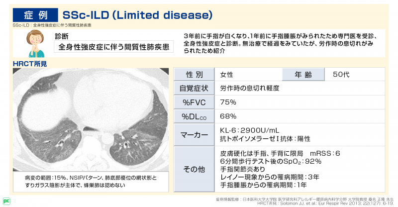 SSc-ILD (Limited disease)