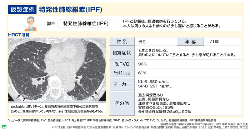 特発性肺線維症(IPF)の予後