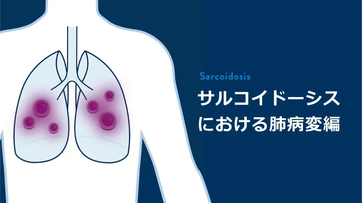 サルコイドーシスにおける肺病変編 (患者さん説明用)