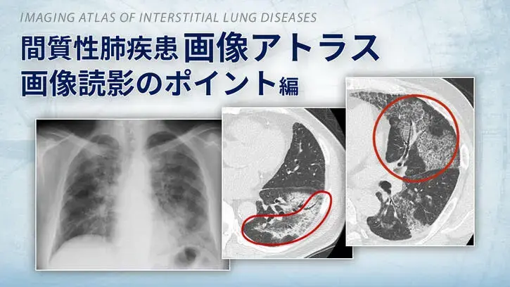 オフェブ関連コンテンツ 間質性肺疾患画像アトラス　画像読影のポイント編